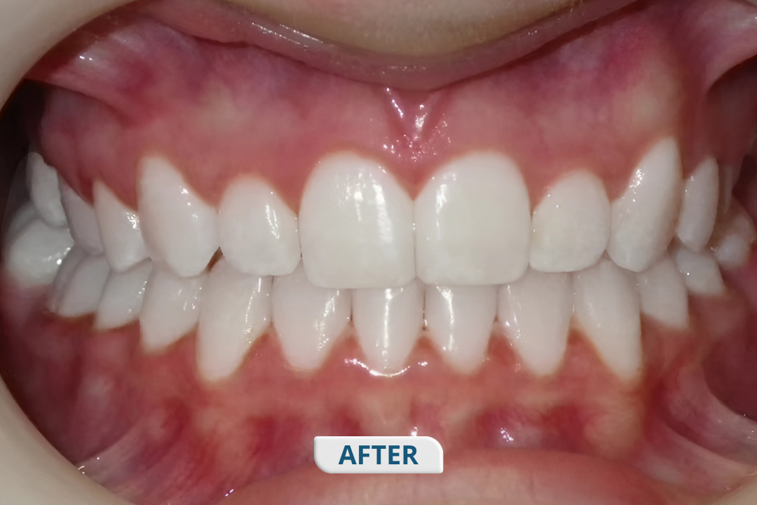 After treatment at Namira Oro Dental Care